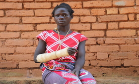 Anna nearly lost her hand when her husband hacked her during a domestic disagreement ©UNFPA/Scott